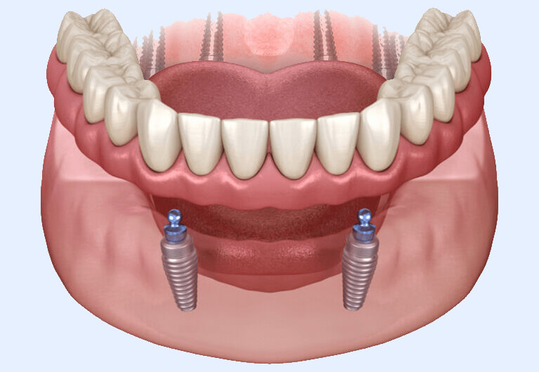 acrylic overdenture - removable and fixed